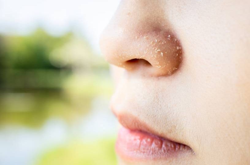 dermatitis-seborreica